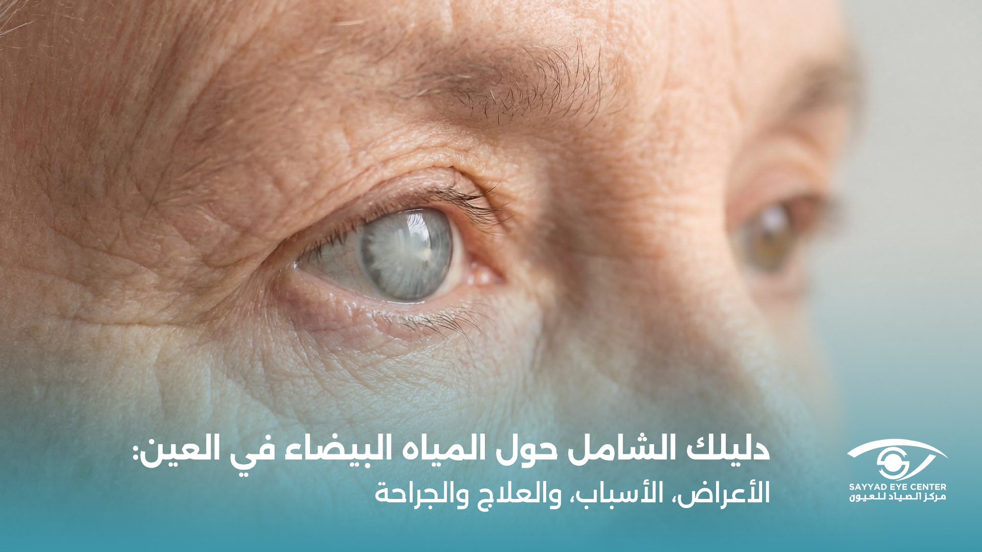 المياه البيضاء في العين: الأعراض والأسباب والجراحة والتعافي